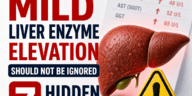 mild liver enzyme elevation